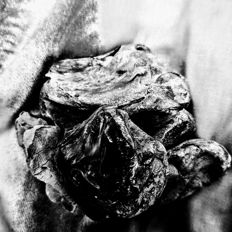 cystic teratoma, 2024